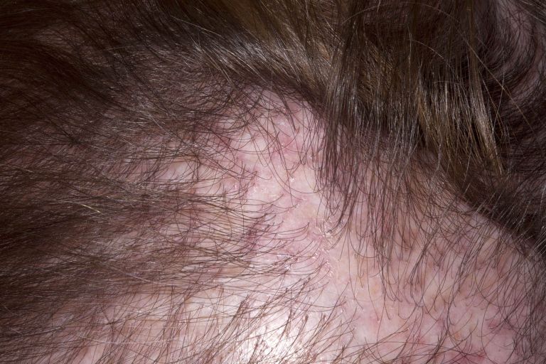 Scarring Hair Loss - British Hair and Nail Society