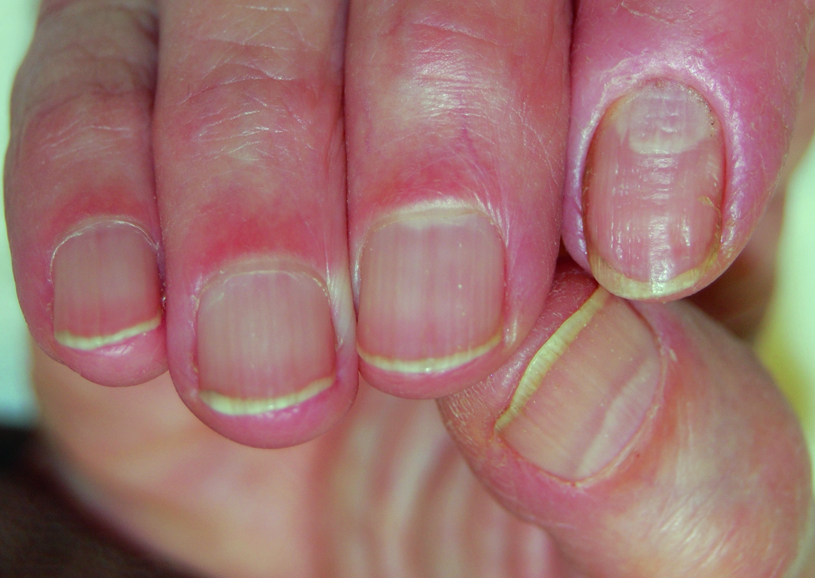 Chronic Paronychia Toe